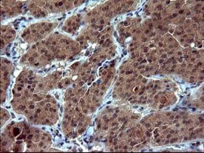 Immunohistochemistry: Tubulin alpha-1B Antibody (OTI3G3) - Azide and BSA Free [NBP2-74703] - Analysis of Carcinoma of Human thyroid tissue.