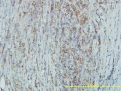 Immunohistochemistry-Paraffin: Tyk2 Antibody (6H1) [H00007297-M03] - Analysis of monoclonal antibody to TYK2 on formalin-fixed paraffin-embedded human lymphoma. Antibody concentration 3 ug/ml