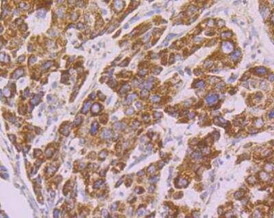 Immunohistochemistry: Tyk2 Antibody [NBP2-76968] - Immunohistochemical analysis of paraffin-embedded human liver cancer tissue using anti-TYK2 antibody. Counter stained with hematoxylin.