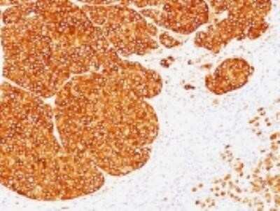 Immunohistochemistry-Paraffin: Tyrosinase Antibody (SPM360) - IHC-Prediluted [NBP2-44684] - Formalin-fixed, paraffin-embedded human melanoma stained with Tyrosinase monoclonal antibody (SPM360).