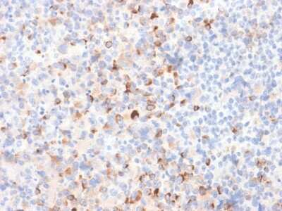 Immunohistochemistry-Paraffin: Tyrosinase Antibody (TYR/2024R) - Azide and BSA Free [NBP3-08892] - Formalin-fixed, paraffin-embedded Melanoma stained with Tyrosinase Rabbit Recombinant Monoclonal Antibody (TYR/2024R).