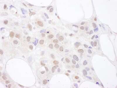 Immunohistochemistry: U2AF2 Antibody [NBP2-04139] - Sample: FFPE section of human breast carcinoma. Antibody: Affinity purified rabbit anti- U2AF65 used at a dilution of 1:1,000 (1ug/ml). Detection: DAB