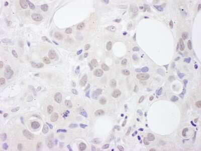 Immunohistochemistry-Paraffin: U2AF2 Antibody [NBP2-04140] - Human breast carcinoma. Antibody: Affinity purified rabbit anti- U2AF65 used at a dilution of 1:1,000 (1ug/ml). Detection: DAB