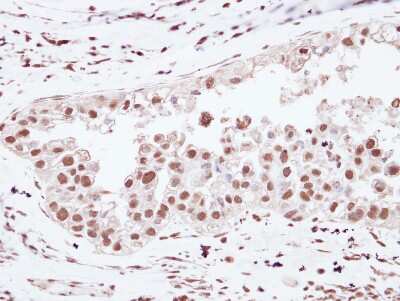 Immunohistochemistry-Paraffin: U2AF2 Antibody [NBP2-20775] - Immunohistochemical analysis of paraffin-embedded OVCA, using antibody at 1:250 dilution.