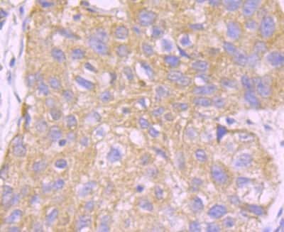 Immunohistochemistry-Paraffin: UAP1 Antibody (4H1) [NBP2-75694] - Analysis of paraffin-embedded human lung cancer tissue using anti-UAP1 antibody. Counter stained with hematoxylin.