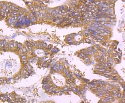 Immunohistochemistry-Paraffin: UAP1 Antibody (4H1) [NBP2-75694] - Analysis of paraffin-embedded human colon cancer tissue using anti-UAP1 antibody. Counter stained with hematoxylin.