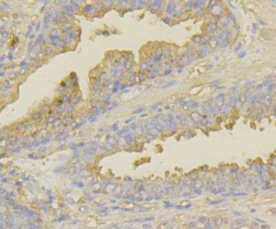 Immunohistochemistry: UAP1 Antibody [NBP2-76970] - Immunohistochemical analysis of paraffin-embedded human prostate cancer tissue using anti-UAP1 antibody. Counter stained with hematoxylin.