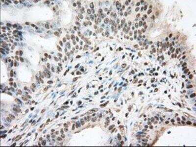 Immunohistochemistry-Paraffin: UAP56 Antibody (2C5) [NBP2-02553] - Staining of paraffin-embedded Adenocarcinoma of Human colon tissue using anti-UAP56 mouse monoclonal antibody.