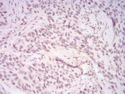 Immunohistochemistry-Paraffin: UAP56 Antibody (3A2B2) [NBP2-52456] - Analysis of cervical cancer tissues using DDX39B mouse mAb with DAB staining.