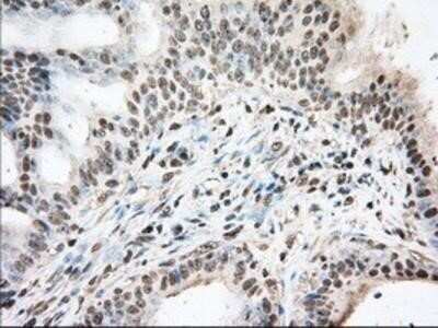 Immunohistochemistry: UAP56 Antibody (OTI2C5) - Azide and BSA Free [NBP2-74727] - Staining of paraffin-embedded Adenocarcinoma of Human colon tissue using anti-UAP56 mouse monoclonal antibody.