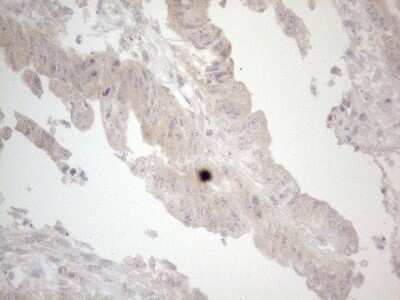 Immunohistochemistry: UBA52 Antibody (4F2) [NBP2-46261] - Analysis of Adenocarcinoma of Human colon tissue. (Heat-induced epitope retrieval by 1mM EDTA in 10mM Tris buffer (pH8.5) at 120C for 3 min)