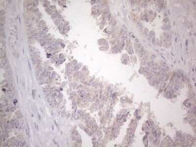 Immunohistochemistry: UBA52 Antibody (4F2) [NBP2-46261] - Analysis of Adenocarcinoma of Human ovary tissue. (Heat-induced epitope retrieval by 1mM EDTA in 10mM Tris buffer (pH8.5) at 120C for 3 min)