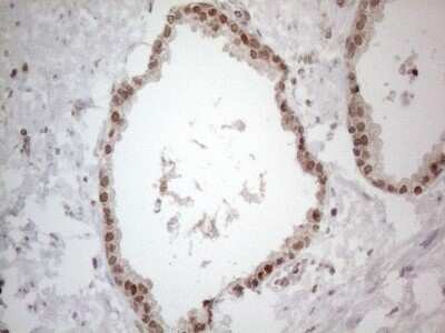 Immunohistochemistry: UBA52 Antibody (4F2) [NBP2-46261] - Analysis of Carcinoma of Human prostate tissue. (Heat-induced epitope retrieval by 1mM EDTA in 10mM Tris buffer (pH8.5) at 120C for 3 min)