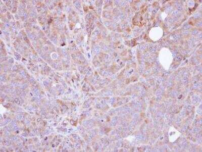 Immunohistochemistry-Paraffin: UBASH3B/STS1/Tula-2 Antibody [NBP1-32592] -  SW480 xenograft , using Steroid sulfatase antibody at 1:100 dilution. Antigen Retrieval: Trilogy™ (EDTA based, pH 8.0) buffer, 15min. 