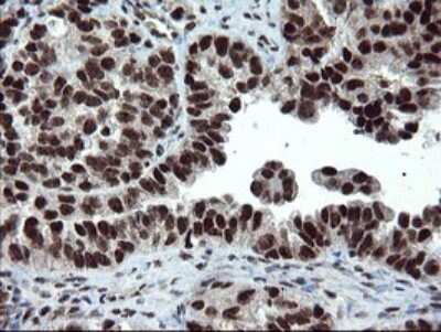 Immunohistochemistry: UBE2E3 Antibody (1B4) [NBP2-46271] - Analysis of Adenocarcinoma of Human ovary tissue.