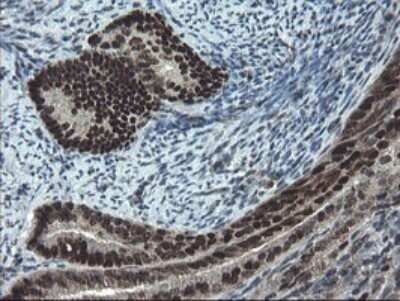 Immunohistochemistry: UBE2E3 Antibody (1B4) [NBP2-46271] - Analysis of Adenocarcinoma of Human endometrium tissue.