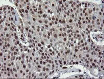 Immunohistochemistry: UBE2E3 Antibody (OTI1B4) - Azide and BSA Free [NBP2-74737] - Analysis of Carcinoma of Human lung tissue.