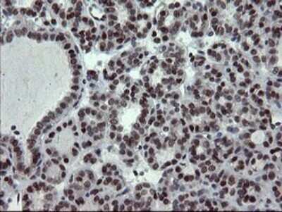 Immunohistochemistry: UBE2E3 Antibody (OTI1B4) - Azide and BSA Free [NBP2-74737] - Analysis of Carcinoma of Human thyroid tissue.