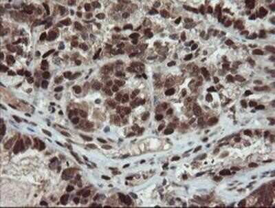 Immunohistochemistry: UBE2E3 Antibody (OTI7E8) - Azide and BSA Free [NBP2-74745] - Staining of paraffin-embedded Adenocarcinoma of Human ovary tissue using anti-UBE2E3 mouse monoclonal antibody.
