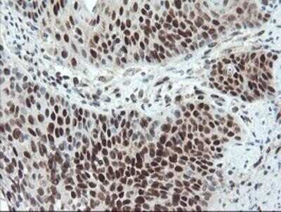 Immunohistochemistry: UBE2E3 Antibody (OTI7E8) - Azide and BSA Free [NBP2-74745] - Staining of paraffin-embedded Carcinoma of Human bladder tissue using anti-UBE2E3 mouse monoclonal antibody.