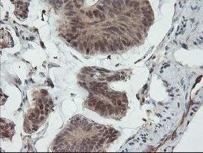 Immunohistochemistry: UBE2E3 Antibody (OTI7E8) - Azide and BSA Free [NBP2-74745] - Staining of paraffin-embedded Carcinoma of Human pancreas tissue using anti-UBE2E3 mouse monoclonal antibody.