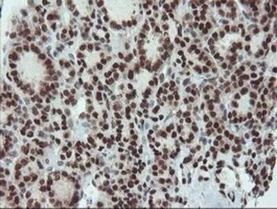 Immunohistochemistry: UBE2E3 Antibody (OTI7E8) - Azide and BSA Free [NBP2-74745] - Staining of paraffin-embedded Carcinoma of Human thyroid tissue using anti-UBE2E3 mouse monoclonal antibody.