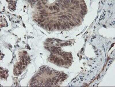 Immunohistochemistry-Paraffin: UBE2E3 Antibody (OTI7E8) [NBP2-03819] - Staining of paraffin-embedded Carcinoma of Human pancreas tissue using anti-UBE2E3 mouse monoclonal antibody.