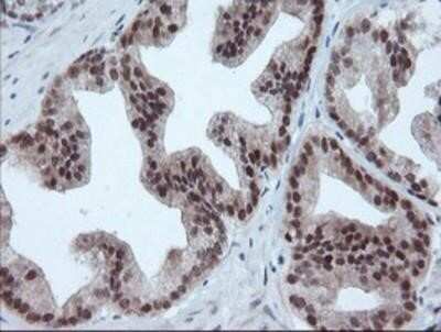 Immunohistochemistry-Paraffin: UBE2E3 Antibody (OTI7E8) [NBP2-03819] - Staining of paraffin-embedded Carcinoma of Human prostate tissue using anti-UBE2E3 mouse monoclonal antibody.