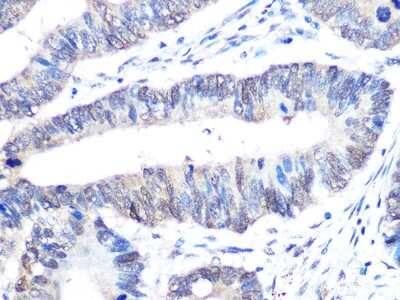 Immunohistochemistry-Paraffin: UBE2I/Ubc9 Antibody (6Z9V6) [NBP3-16400] - Immunohistochemistry of paraffin-embedded human colon carcinoma using UBE2I/Ubc9 Rabbit mAb (NBP3-16400) at dilution of 1:100 (40x lens).Perform microwave antigen retrieval with 10 mM PBS buffer pH 7.2 before commencing with IHC staining protocol.