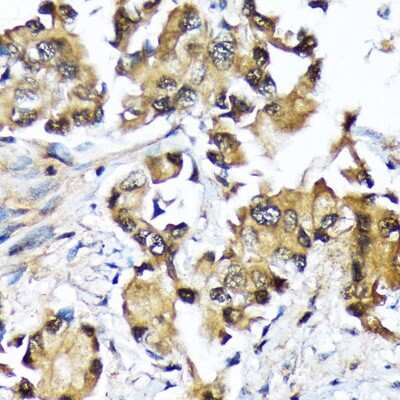 Immunohistochemistry-Paraffin: UBE2N/Ubc13 Antibody (10O9Z5) [NBP3-16793] - Immunohistochemistry of paraffin-embedded human lung cancer using UBE2N/Ubc13 Rabbit mAb (NBP3-16793) at dilution of 1:100 (40x lens).Perform microwave antigen retrieval with 10 mM Tris/EDTA buffer pH 9.0 before commencing with IHC staining protocol.