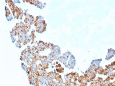 Immunohistochemistry-Paraffin: UBE2R1/CDC34 Antibody (CPTC-CDC34-2) [NBP3-07514] - Formalin-fixed, paraffin-embedded human Breast Carcinoma stained with UBE2R1/CDC34 Mouse Monoclonal Antibody (CPTC-UBE2R1/CDC34-2).
