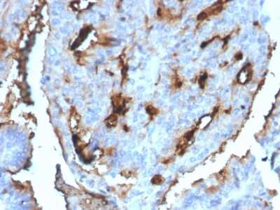 Immunohistochemistry-Paraffin: UBE2R1/CDC34 Antibody (CPTC-CDC34-2) [NBP3-07514] - Formalin-fixed, paraffin-embedded human Breast Carcinoma stained with UBE2R1/CDC34 Mouse Monoclonal Antibody (CPTC-UBE2R1/CDC34-2).
