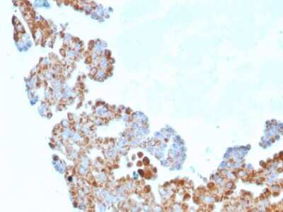 Immunohistochemistry-Paraffin: UBE2R1/CDC34 Antibody (CPTC-CDC34-2) [NBP3-08839] - Formalin-fixed, paraffin-embedded human Breast Carcinoma stained with UBE2R1/CDC34 Mouse Monoclonal Antibody (CPTC-UBE2R1/CDC34-2).