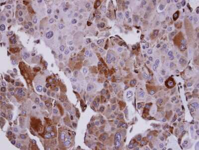 Immunohistochemistry-Paraffin: UBE2T Antibody [NBP2-20789] - Immunohistochemical analysis of paraffin-embedded Adrenal gland tumor, using antibody at 1:100 dilution.
