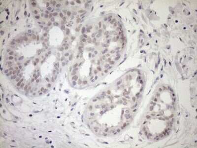 Immunohistochemistry: UBP1 Antibody (9G7) [NBP2-46288] - Analysis of Adenocarcinoma of Human breast tissue. (Heat-induced epitope retrieval by 1mM EDTA in 10mM Tris buffer (pH8.5) at 120C for 3 min)