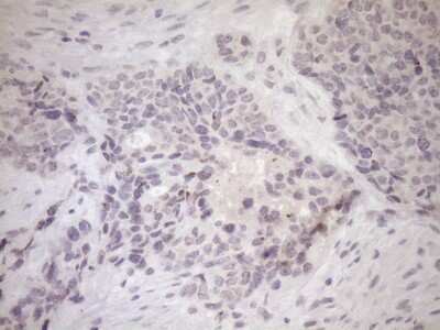 Immunohistochemistry: UBP1 Antibody (9G7) [NBP2-46288] - Analysis of Adenocarcinoma of Human endometrium tissue. (Heat-induced epitope retrieval by 1mM EDTA in 10mM Tris buffer (pH8.5) at 120C for 3 min)