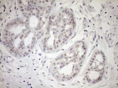 Immunohistochemistry: UBP1 Antibody (OTI9G7) - Azide and BSA Free [NBP2-74761] - Analysis of Adenocarcinoma of Human breast tissue. (Heat-induced epitope retrieval by 1mM EDTA in 10mM Tris buffer (pH8.5) at 120C for 3 min)