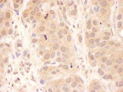 <b>Independent Antibodies Validation and Biological Strategies Validation.</b>Immunohistochemistry-Paraffin: UBPY/USP8 Antibody [NBP1-50001] - FFPE section of human breast carcinoma. Antibody: Affinity purified rabbit anti-USP8 (NBP1-50001) used at a dilution of 1:200 (1ug/ml). Detection: DAB