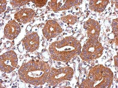 Immunohistochemistry-Paraffin: UBPY/USP8 Antibody [NBP2-20792] - Immunohistochemical analysis of paraffin-embedded Colon ca, using antibody at 1:500 dilution.