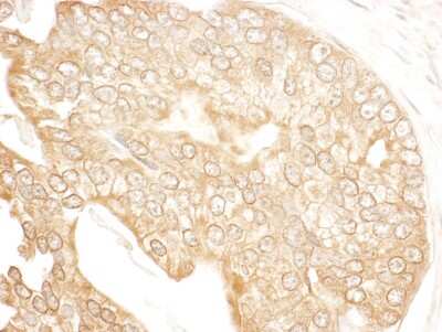 Immunohistochemistry: UBR4 Antibody [NBP1-28724] - Sample: FFPE section of human prostate carcinoma. Antibody: Affinity purified rabbit anti- p600 used at a dilution of 1:200 (1ug/ml). Detection: DAB