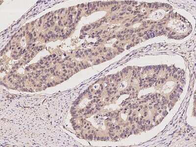 Immunohistochemistry-Paraffin: UBTD2 Antibody [NBP2-98563] - Immunochemical staining of human UBTD2 in human colon carcinoma with rabbit polyclonal antibody at 1:100 dilution, formalin-fixed paraffin embedded sections.