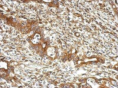 Immunohistochemistry-Paraffin: UBXN1 Antibody [NBP2-20795] - Immunohistochemical analysis of paraffin-embedded Colon ca, using antibody at 1:500 dilution.