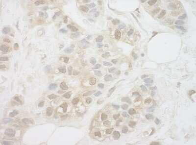 <b>Independent Antibodies Validation and Biological Strategies Validation.</b>Immunohistochemistry-Paraffin: UCKL1 Antibody [NBP1-42680] - FFPE section of human breast carcinoma. Antibody: Affinity purified rabbit anti-UCKL1 used at a dilution of 1:200 (1ug/ml) Detection: DAB