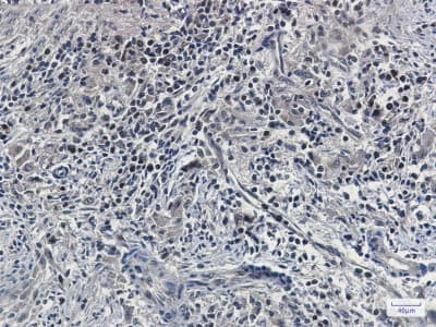 Immunohistochemistry-Paraffin: UFM1 Antibody (S02-5G1) [NBP3-19488] - Immunohistochemistry of UFM1 in paraffin-embedded human lung cancer tissue using NBP3-19488 at dilution 1/100