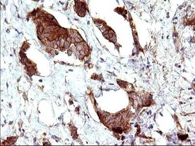 Immunohistochemistry-Paraffin: UIP1 Antibody (OTI1E8) [NBP2-45932] - Analysis of Adenocarcinoma of Human breast tissue. (Heat-induced epitope retrieval by 10mM citric buffer, pH6.0, 120C for 3min)