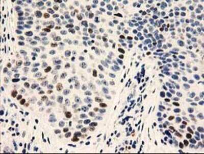 Immunohistochemistry: UNG Antibody (OTI1A11) - Azide and BSA Free [NBP2-74785] - Staining of paraffin-embedded Carcinoma of Human bladder tissue using anti-uracil-DNA glycosylase mouse monoclonal antibody.