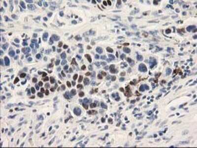 Immunohistochemistry: UNG Antibody (OTI1A11) - Azide and BSA Free [NBP2-74785] - Staining of paraffin-embedded Carcinoma of Human luracil-DNA glycosylase tissue using anti-uracil-DNA glycosylase mouse monoclonal antibody.