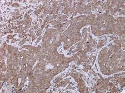 Immunohistochemistry-Paraffin: UPF3B Antibody [NBP3-12932] - UPF3B antibody detects UPF3B protein at cytoplasm in AsPC-1 xenograft by immunohistochemical analysis. Sample: Paraffin-embedded AsPC-1 xenograft. UPF3B antibody (NBP3-12932) diluted at 1:500. Antigen Retrieval: Citrate buffer, pH 6.0, 15 min