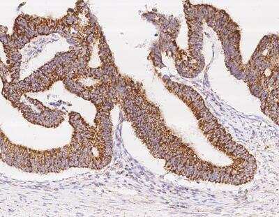 Immunohistochemistry-Paraffin: UQCRB Antibody [NBP3-12711] - Staining of human UQCRB in human colon carcinoma with rabbit polyclonal antibody at 1:5000 dilution.