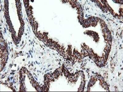 Immunohistochemistry-Paraffin: UQCRC1 Antibody (OTI1G6) [NBP2-03825] - Staining of paraffin-embedded Carcinoma of Human prostate tissue using anti-UQCRC1 mouse monoclonal antibody.